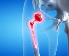 direct_anterior_approach_in_total_hip_replacement_m_.webp